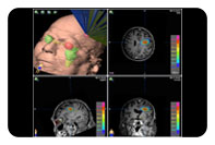 New Stereotactic Radiosurgery Treatment Option for Brain Tumors and Other Conditions