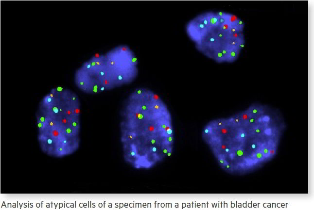Analysis of atypical cells of a specimen from a patient with bladder cancer