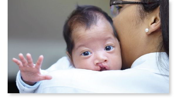 Baby with craniofacial defect